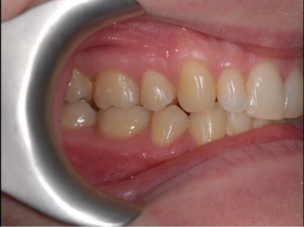 Invisalign case 3 after