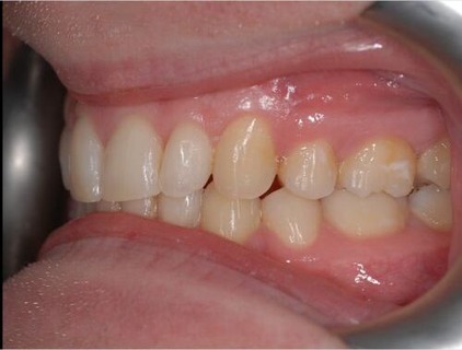 Invisalign case 3 after