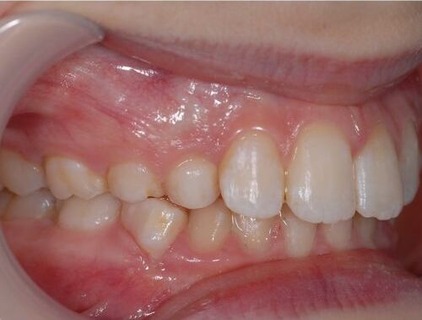 Invisalign case 4 after