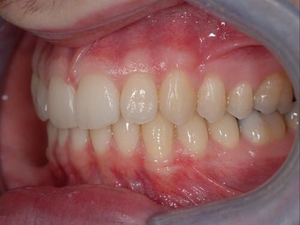 Invisalign case 1 after