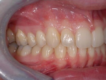 Invisalign case 1 after