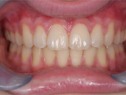 Invisalign case 2 after