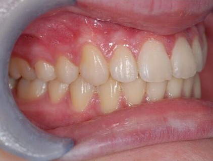 Invisalign case 2 after